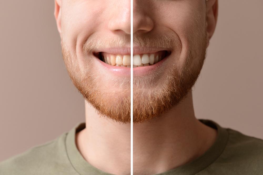 teeth whitening before and after | teeth whitening lara vic