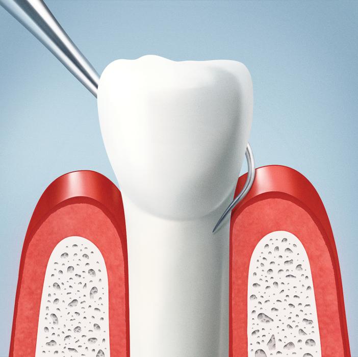 close up of tooth with dental tool | tooth replacements lara